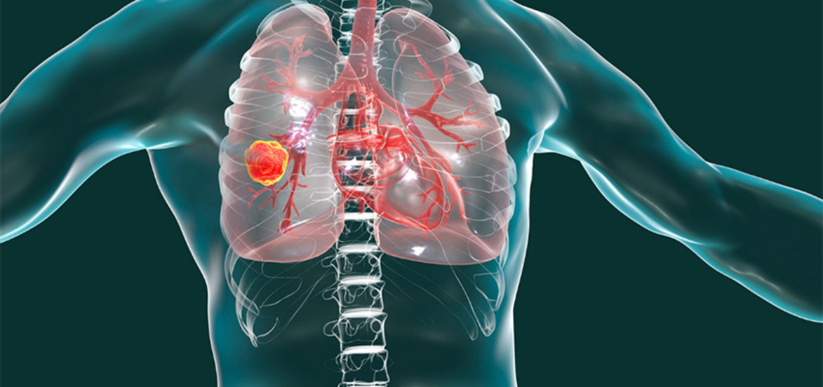 ICAPEM pone sobre la mesa la realidad del cáncer de pulmón 8