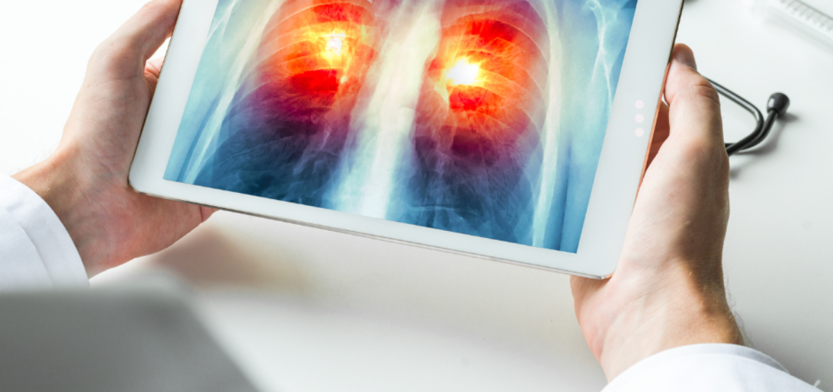 ICAPEM alerta: “Cualquier persona puede sufrir cáncer de pulmón” 2